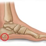 Rimedi naturali per il sperone calcaneare: rimedi che alleviano il dolore e aiutano nella guarigione
