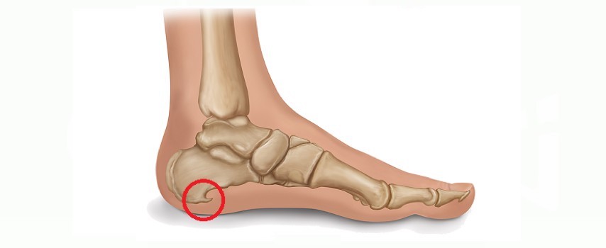 Rimedi naturali per il sperone calcaneare: rimedi che alleviano il dolore e aiutano nella guarigione