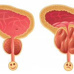 Come prendersi cura della propria prostata con 3 rimedi naturali efficaci