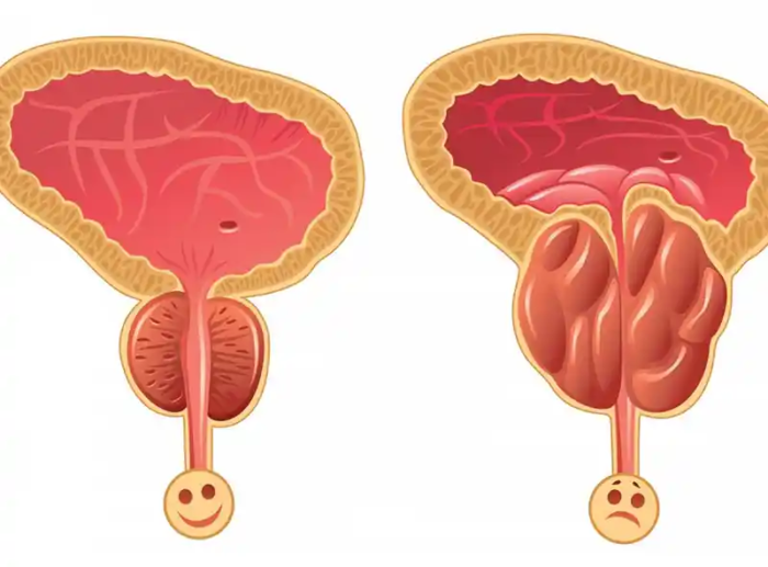 Come prendersi cura della propria prostata con 3 rimedi naturali efficaci