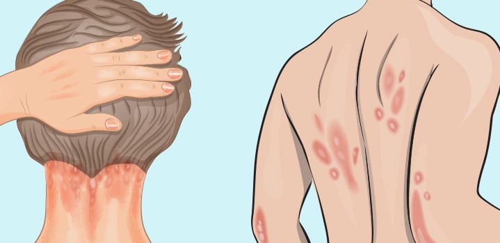Psoriasi: cause, sintomi e rimedi