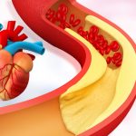 Dieta per colesterolo alto. Alimenti da evitare e alimenti benefici per ridurre i grassi nel sangue