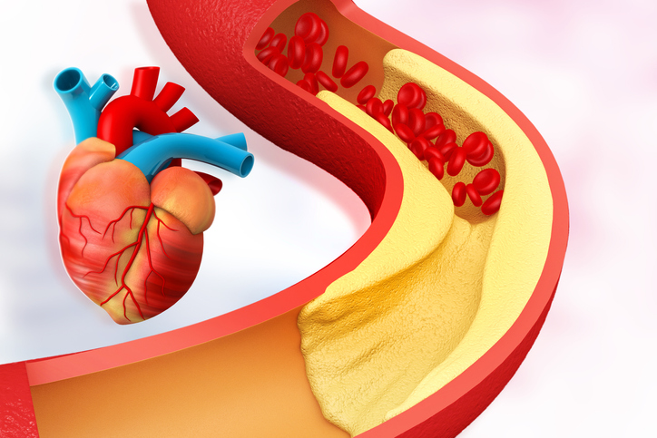 Dieta per colesterolo alto. Alimenti da evitare e alimenti benefici per ridurre i grassi nel sangue