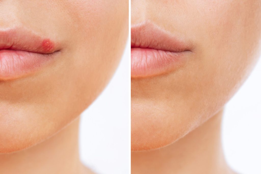 Rimedi economici per trattare l’herpes