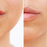 Rimedi economici per trattare l’herpes