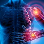 I rimedi più efficaci per il reumatismo: risultati eccezionali