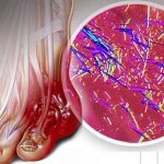 5 modi per purificare le articolazioni dall’eccesso di acido urico