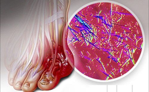 5 modi per purificare le articolazioni dall’eccesso di acido urico