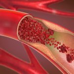 I migliori alimenti che fluidificano il sangue e come prevenire la trombosi venosa