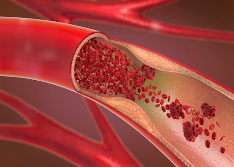 I migliori alimenti che fluidificano il sangue e come prevenire la trombosi venosa