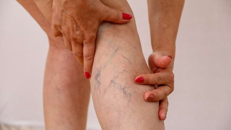 Varici: cause, rimedi naturali e ricette da terapeuti rinomati per gambe leggere e una migliore circolazione