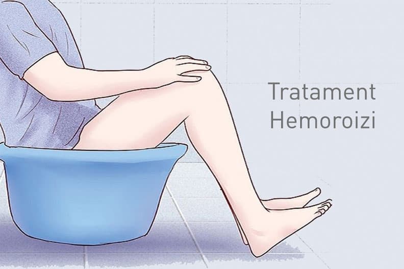 Le migliori piante per il trattamento delle emorroidi e come utilizzarle: consigli e raccomandazioni