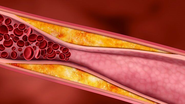 10 alimenti che prevengono l’indurimento dei vasi sanguigni