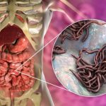 Alimenti con effetto antiparassitario: liberati naturalmente dai vermi intestinali